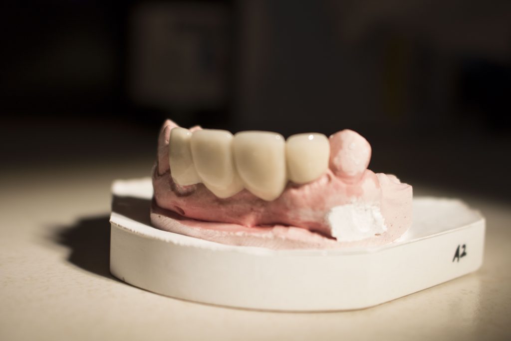 4unitbridgeanterior2018 DENTIST3