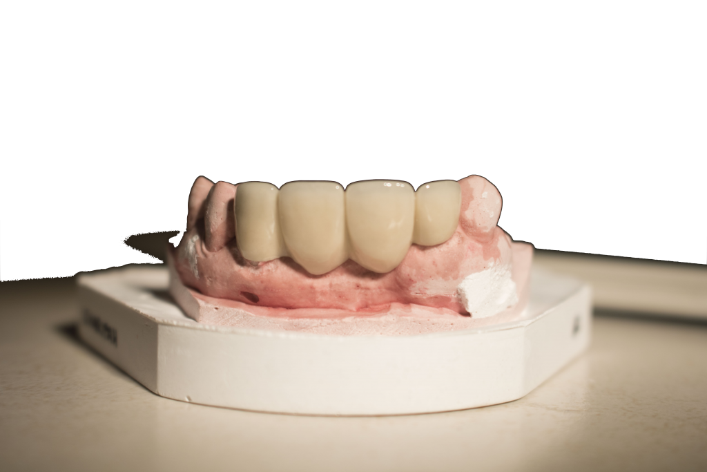 4unitbridgeanterior2018_1 DENTIST3