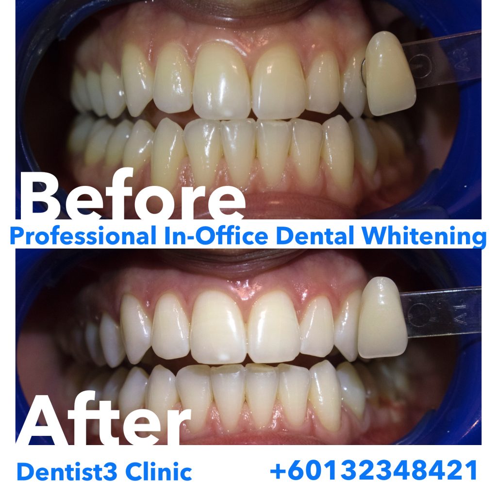 Dental Whitening Dentists Malaysia