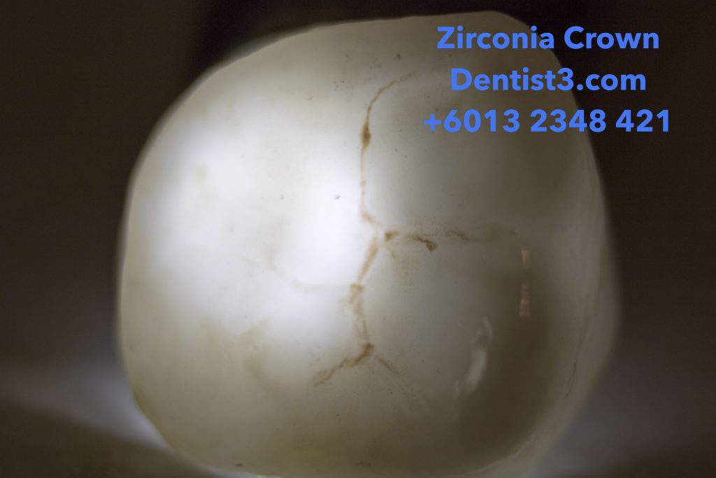 Zirconia Crown & Bridge Malaysia