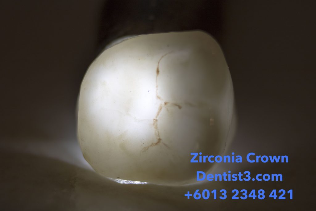Zirconia Crown & Bridge Malaysia