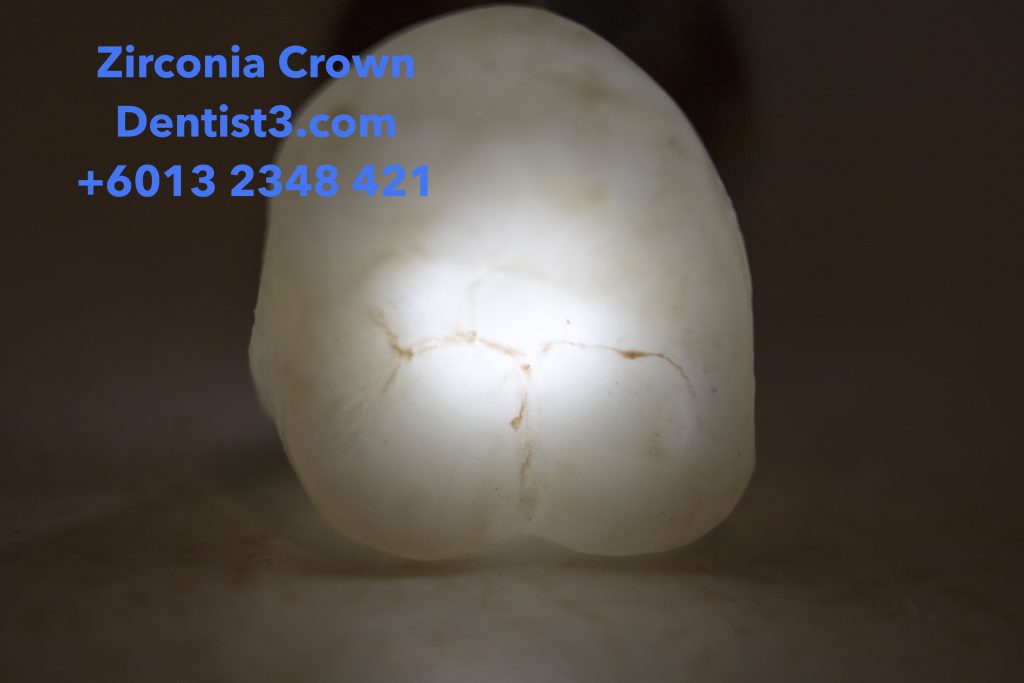 Zirconia Crown & Bridge Malaysia