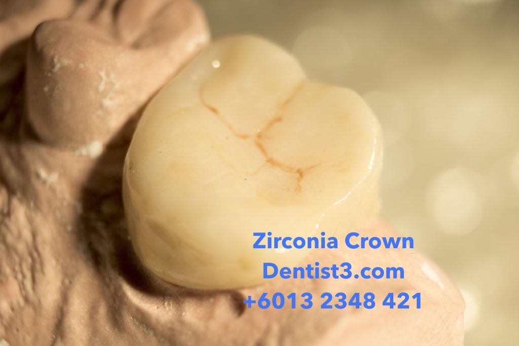 Zirconia Crown & Bridge Malaysia