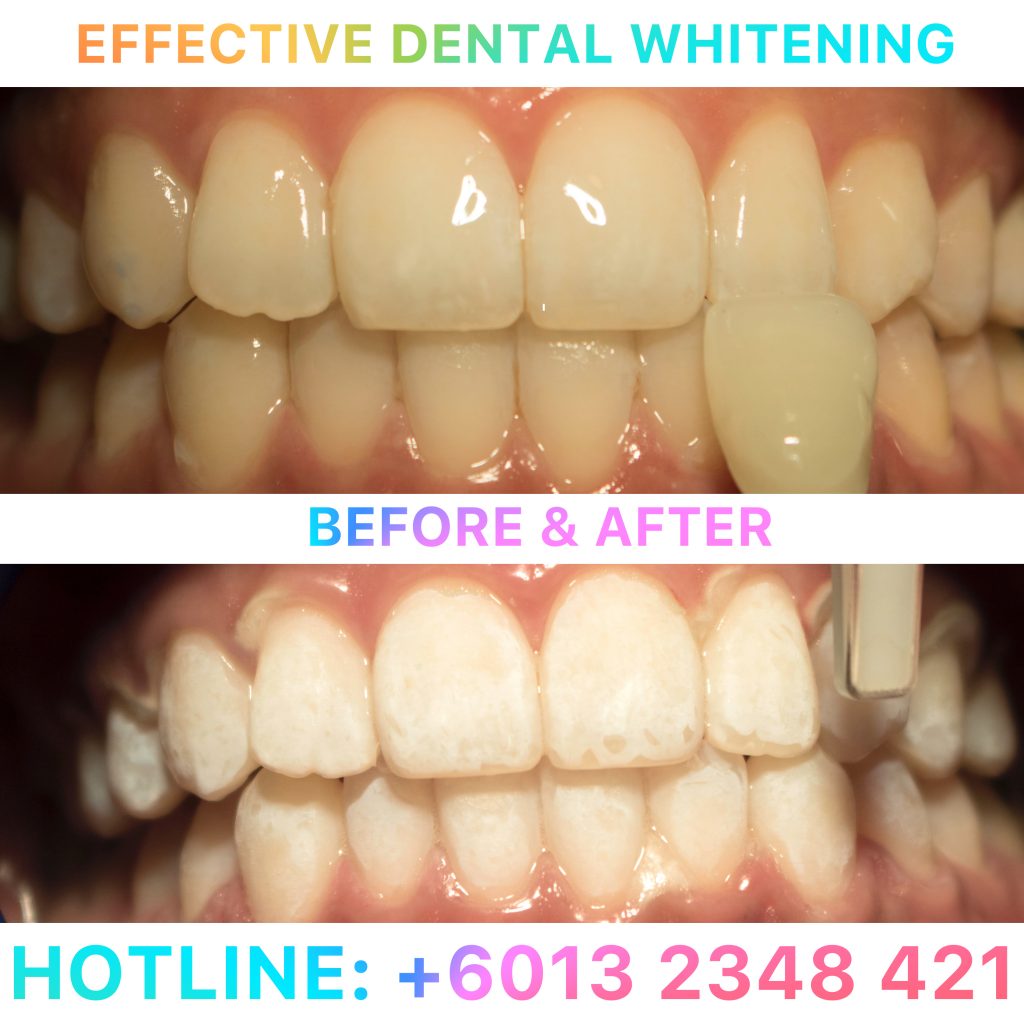 effective-dental-whitening-jpeg