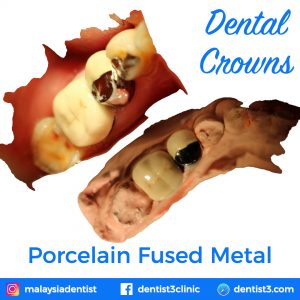 porcelain-fused-metal-crowns