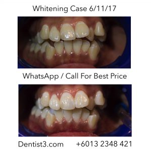 whitening-siti-before-after