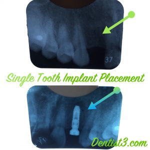 1st-implant-placement-dentist3