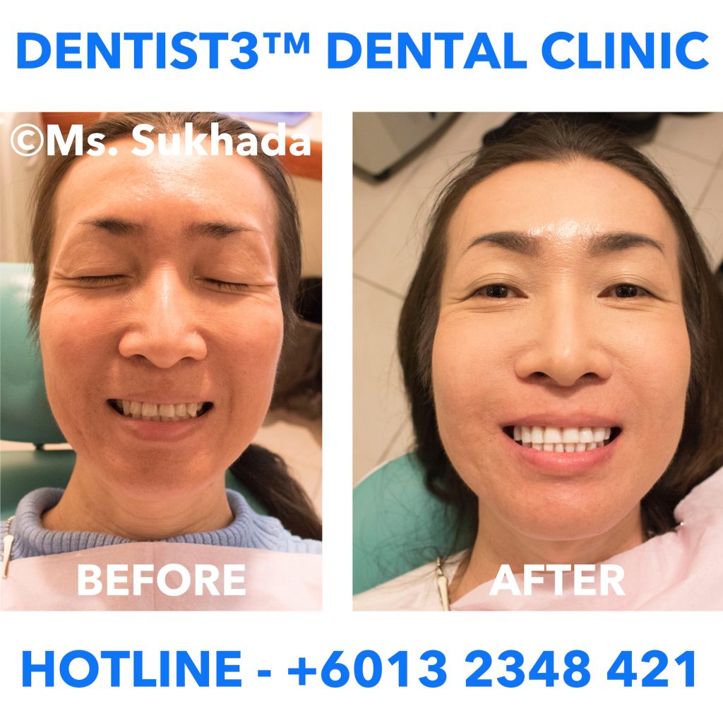 3M-16-UNITS-VENEERS  Dentist Malaysia