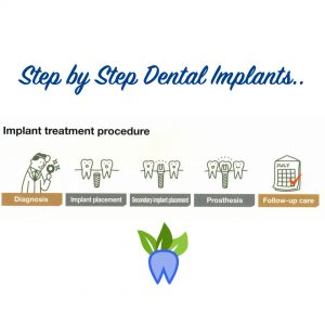 step-by-step-dental-implants