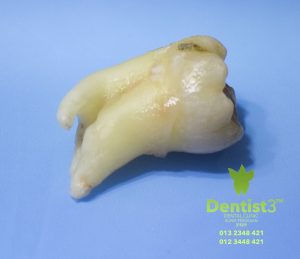 wisdom-tooth-removal-malaysia
