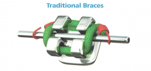 Conventional-braces-dentist-malaysia