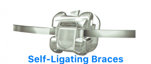 SElf-ligating-braces-dentist-malaysia