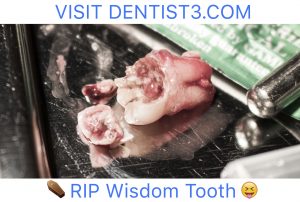 third-molar-pregnant-pt-2018