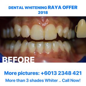whitening-raya-offer-2018