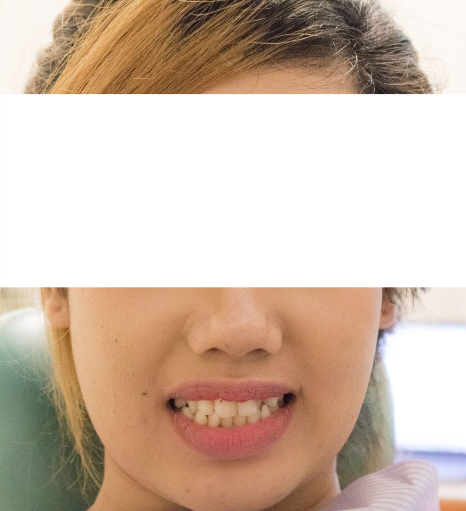 Edited-6-unit-anterior-composite-veneer-alyanie-2018_1 