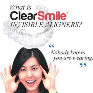 clear-smile-clear-aligners