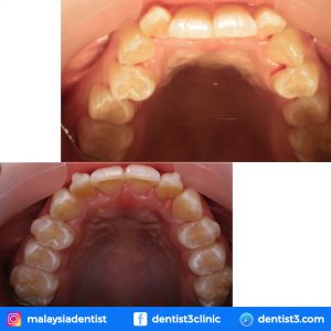 dentist3-eliza-clear-aligner
