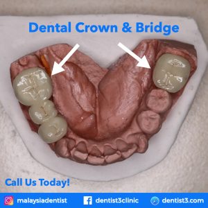 crown-Bridge-dentist3