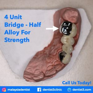 dental-bridge-4-units