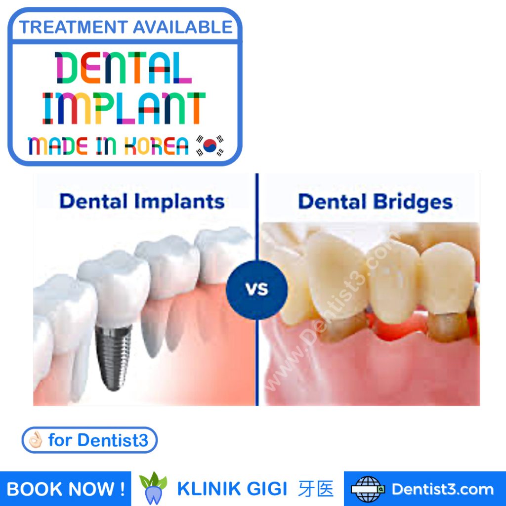 Dental Implants compared to Dental Bridges 