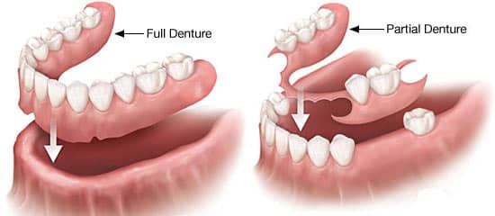 full and removable dentures