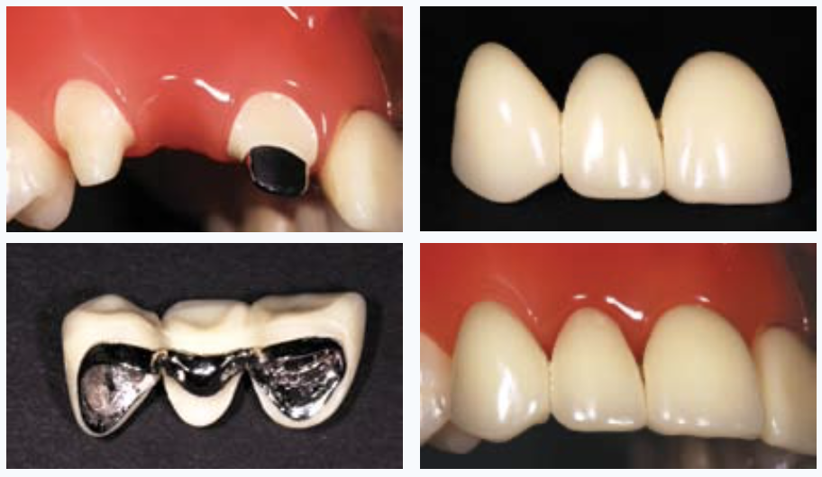 In Malaysia, dental bridges are more commonly done to replace missing tooth compared to dental implants