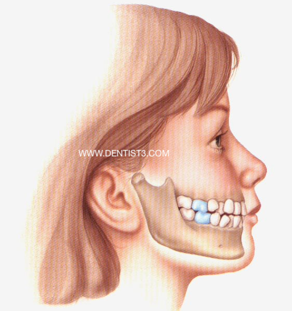 Class one malocclusion