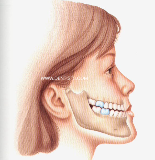 Class Ill: The lower jaw has
 outgrown the upper jaw, causing an
 underbite.