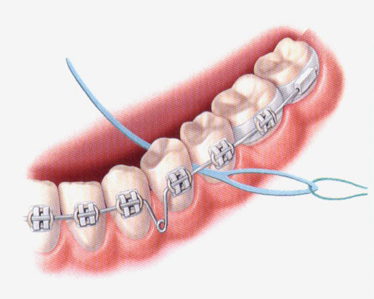 Flossing is more challenging because of the
 archwire. Your dentist can show you how to floss using a device called a floss threader. This allows you to pass the floss underneath the archwire.