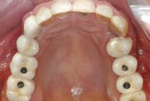Screw retained crowns with access holes before being sealed with tooth-coloured fillings