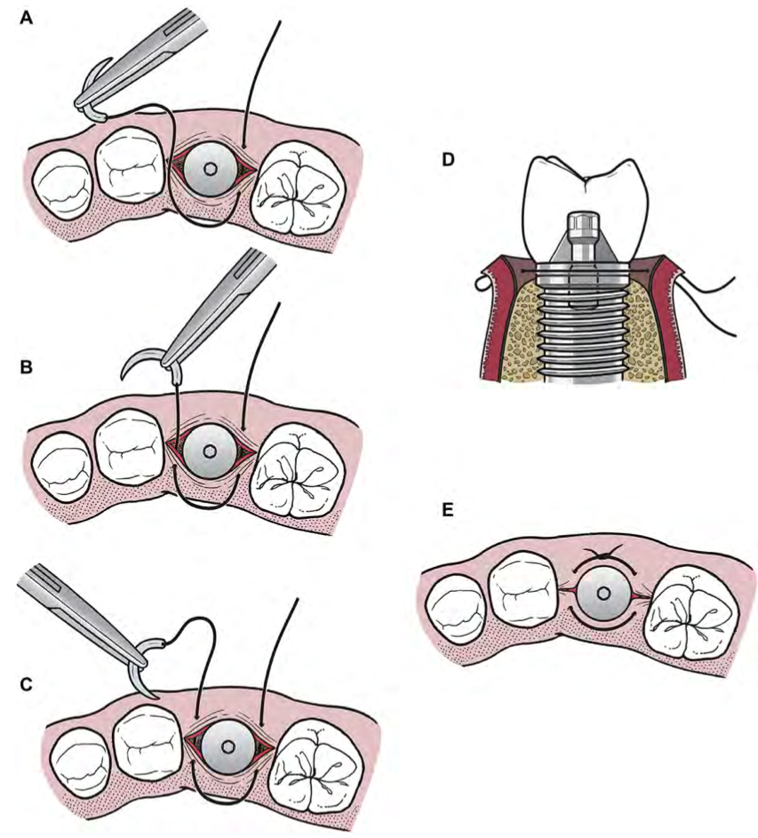 Suturing a Dental Implant (one-stage Implant)