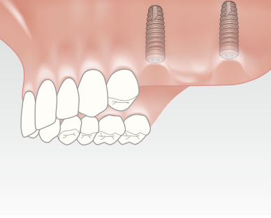Two or more implants serve as the new roots for the new teeth.