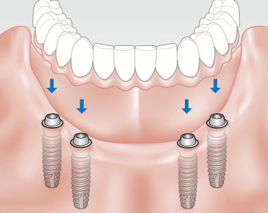 Abutments act as connect- ing elements between the bridge and the implants.