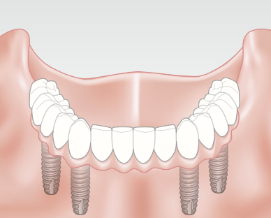 The dental implant bridge, attached directly to the abutments, creating a secure and permanent solution.