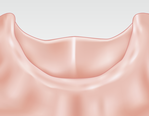 An overdenture is supported by at least two dental im- plants and is a more secure, but removable, alternative to dentures.