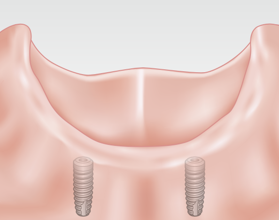 Two or more dental implants, creating a secure foundation for the final prosthesis.