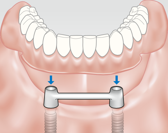Ball abutments or a bar act as the intermediate connecting element to the implants.