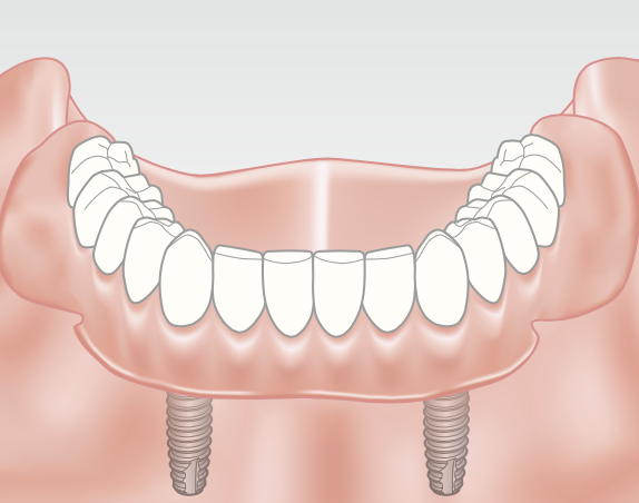 With an overdenture in place, functionality and ap- pearance of normal teeth is created.