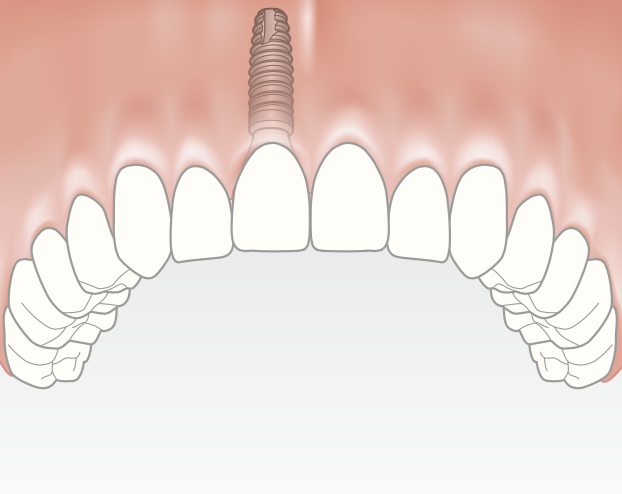 The new tooth (crown) is attached to the abutment, renewing the smile.