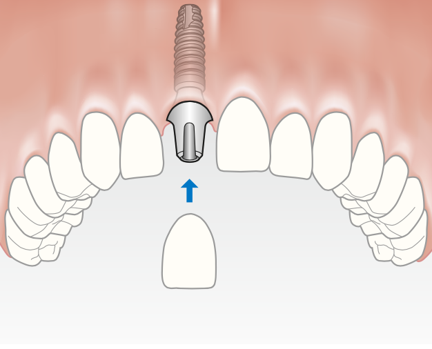 The abutment is attached to the dental implant.