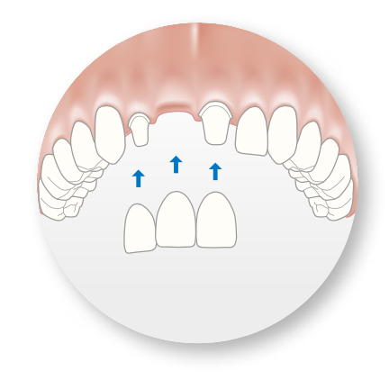 Unlike dental implant treatment, traditional bridges replacing a single tooth or several teeth use adjacent healthy teeth, which must be ground down, for support. Moreover, implant solutions stimulate the underlying jawbone, resulting in preserved bone and gums.