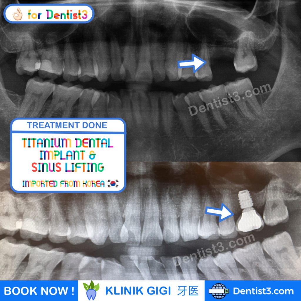 Upper Dental Implant + Sinus Lifting done at Dentist3™ Dental Clinic