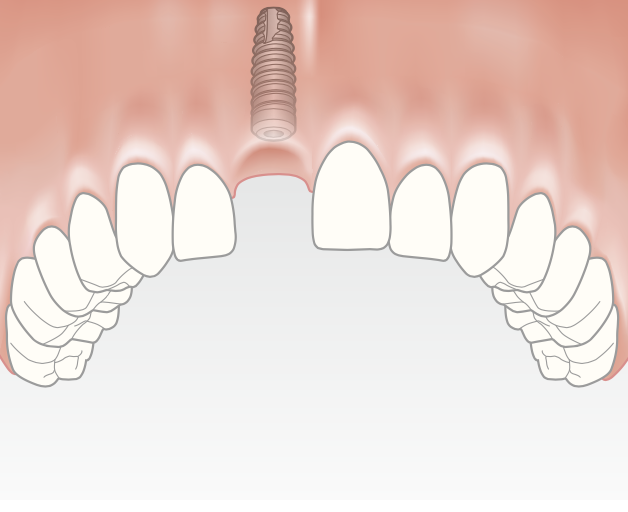 The dental implant is inserted into the jawbone without affecting adjacent teeth.