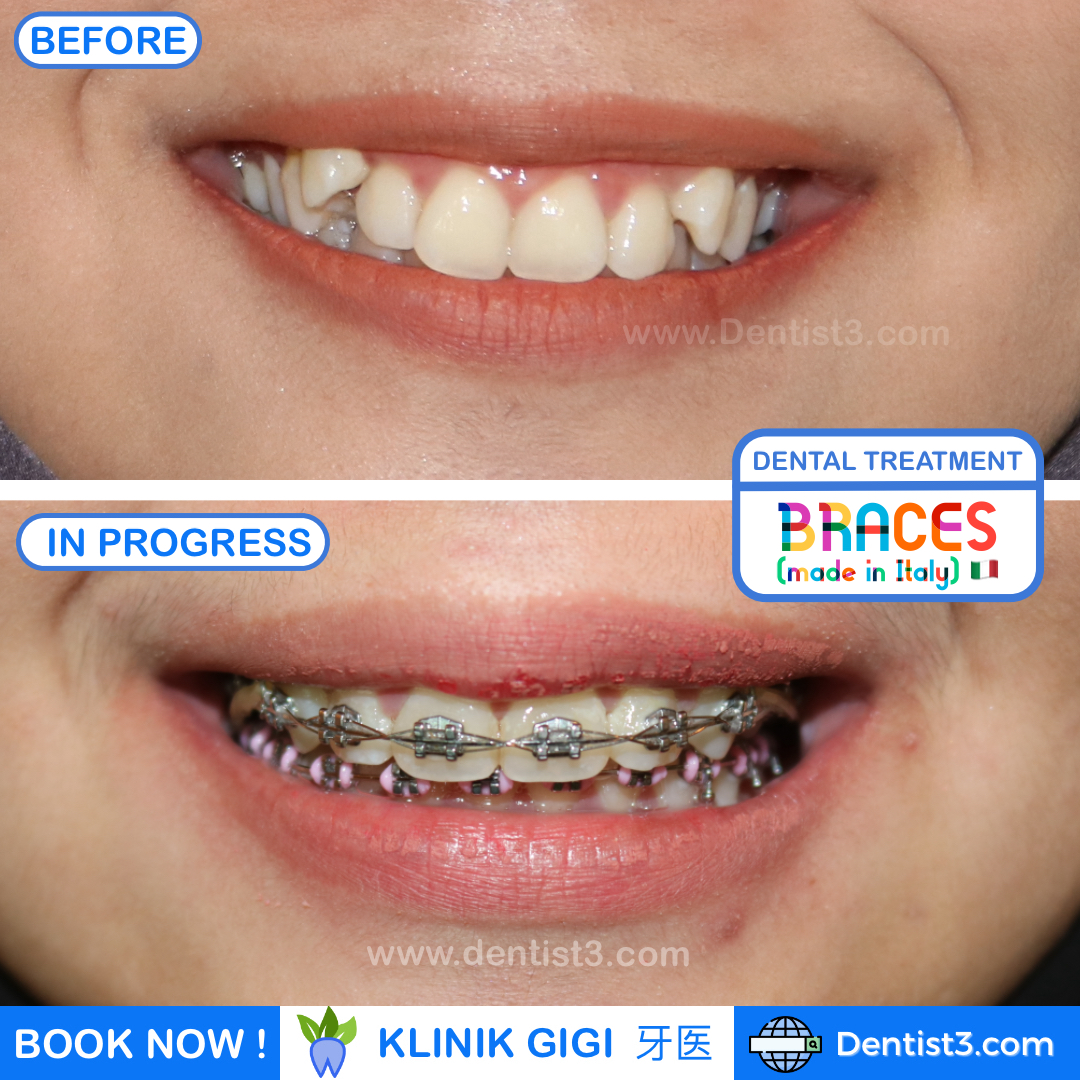 Harga Buat Braces Di Klinik Kerajaan / Harga Pasang Braces Swasta ...