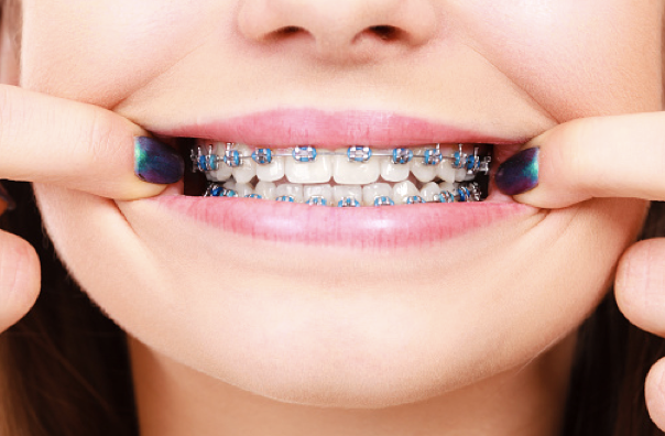 Gambar 1: Keperluan pendakap gigi sebahagian besar ditentukan oleh biologi.