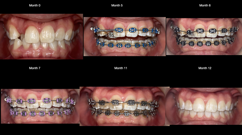 progress details of this particular braces treatment 