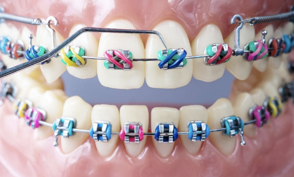 Orthodontics (braces) is a dentistry specialty that addresses the diagnosis, prevention, and correction of mal-positioned (crooked) teeth and jaws, and misaligned bite patterns. It may also address the modification of facial growth, known as dentofacial orthopedics.