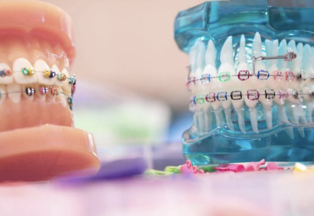 Orthodontics (braces) is a dentistry specialty that addresses the diagnosis, prevention, and correction of mal-positioned (crooked) teeth and jaws, and misaligned bite patterns.