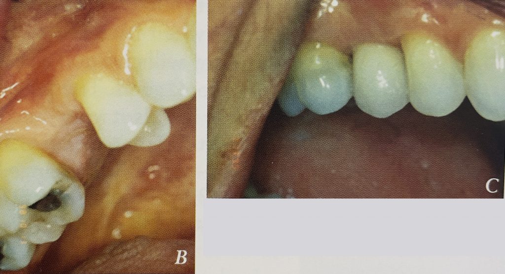 B,C Before and after picture of a single-tooth implant.