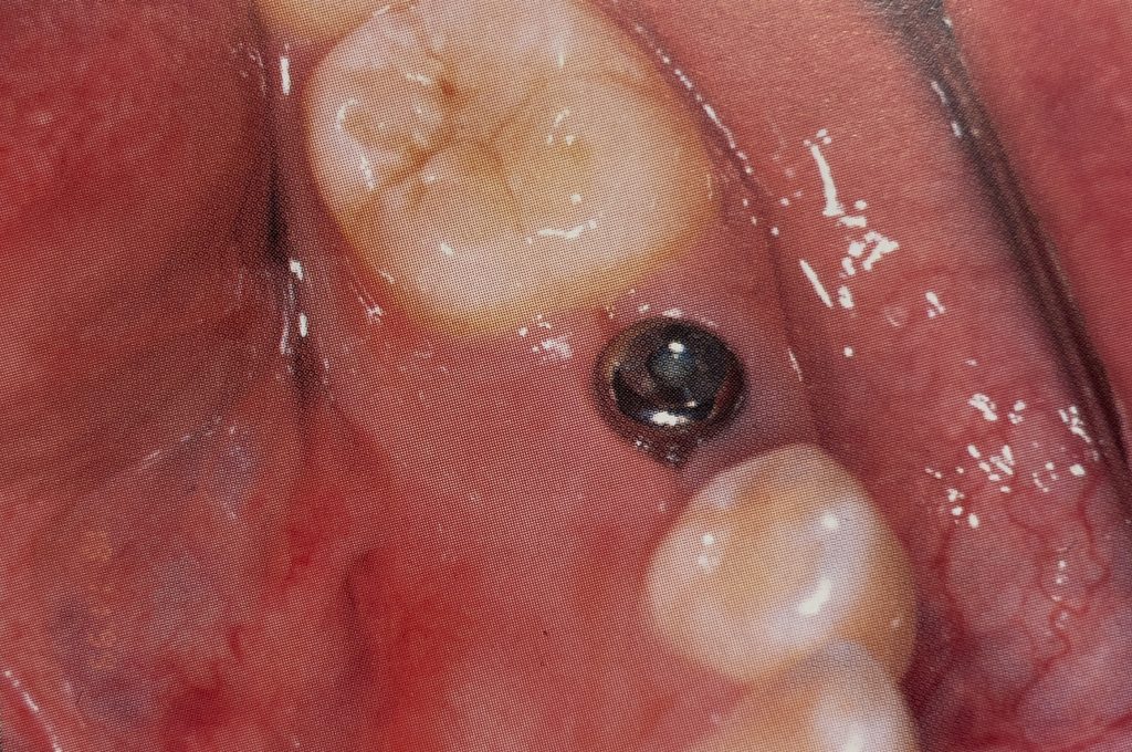 In this case, the healing abutment was placed at the time the dental implant was placed. Therefore, no second surgery was required.